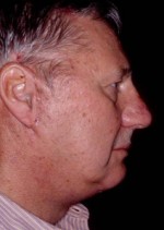 Facelift