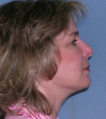 Facelift