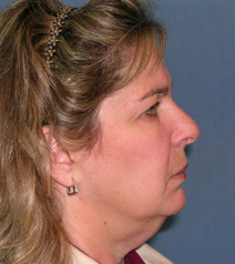 Facelift Before and After Photos