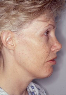 Facelift Before and After Photos