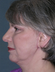 Facelift Before and After Photos