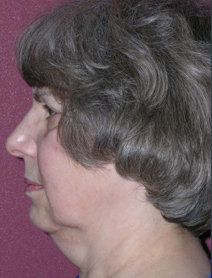 Facelift Before and After Photos