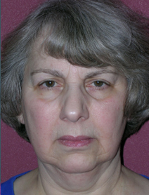 Facelift Before and After Photos