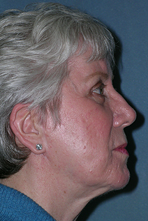 Facelift Before and After Photos