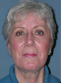 Facelift Before and After Photos