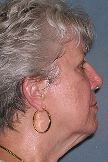 Facelift Before and After Photos