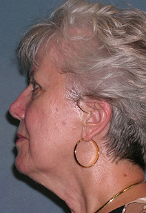 Facelift Before and After Photos