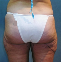 Body Liposculpture Before and After Photos