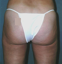 Body Liposculpture Before and After Photos