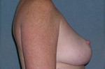 Breast Reduction