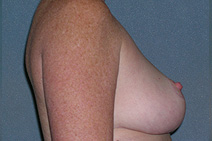 Breast Reduction Case 3683 After Photo Breast Reduction