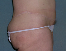 Belt Lipectomy Case 3695 After Photo Belt Lipectomy