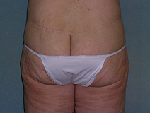 Belt Lipectomy Case 3695 After Photo Belt Lipectomy