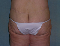 Before After Photos Belt Lipectomy