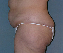 Before After Photos Belt Lipectomy