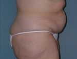 Belt Lipectomy