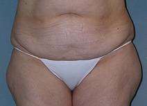 Before After Photos Belt Lipectomy