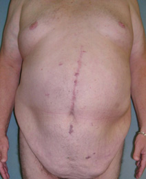 Tummy Tuck Before and After Photos