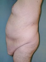 Tummy Tuck