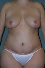 Breast and Abdomen