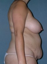 Breast and Abdomen