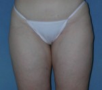 Thigh Lift