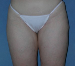 Thigh Lift Case 3791 After Photo Thigh Lift
