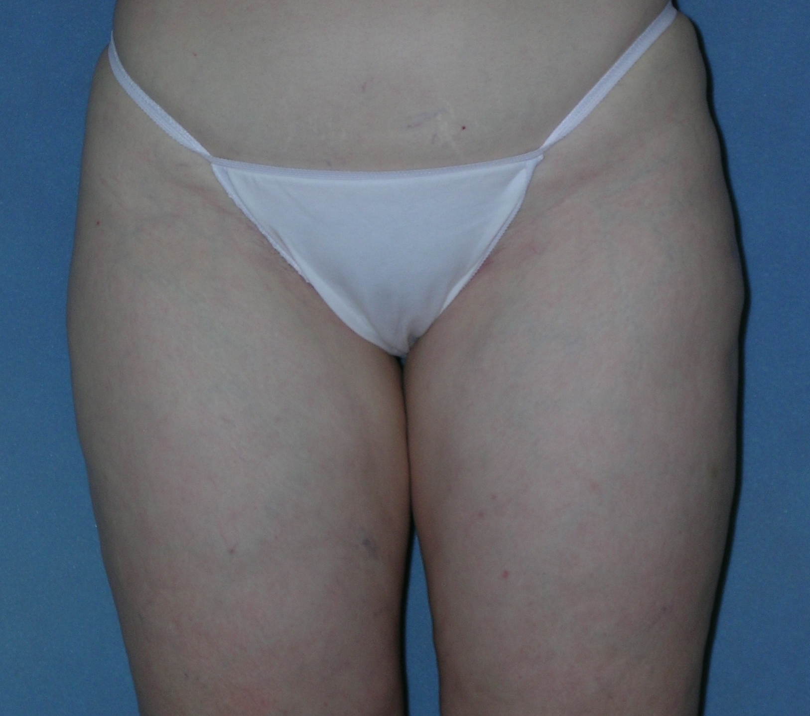 Thigh Lift Before and After Photos