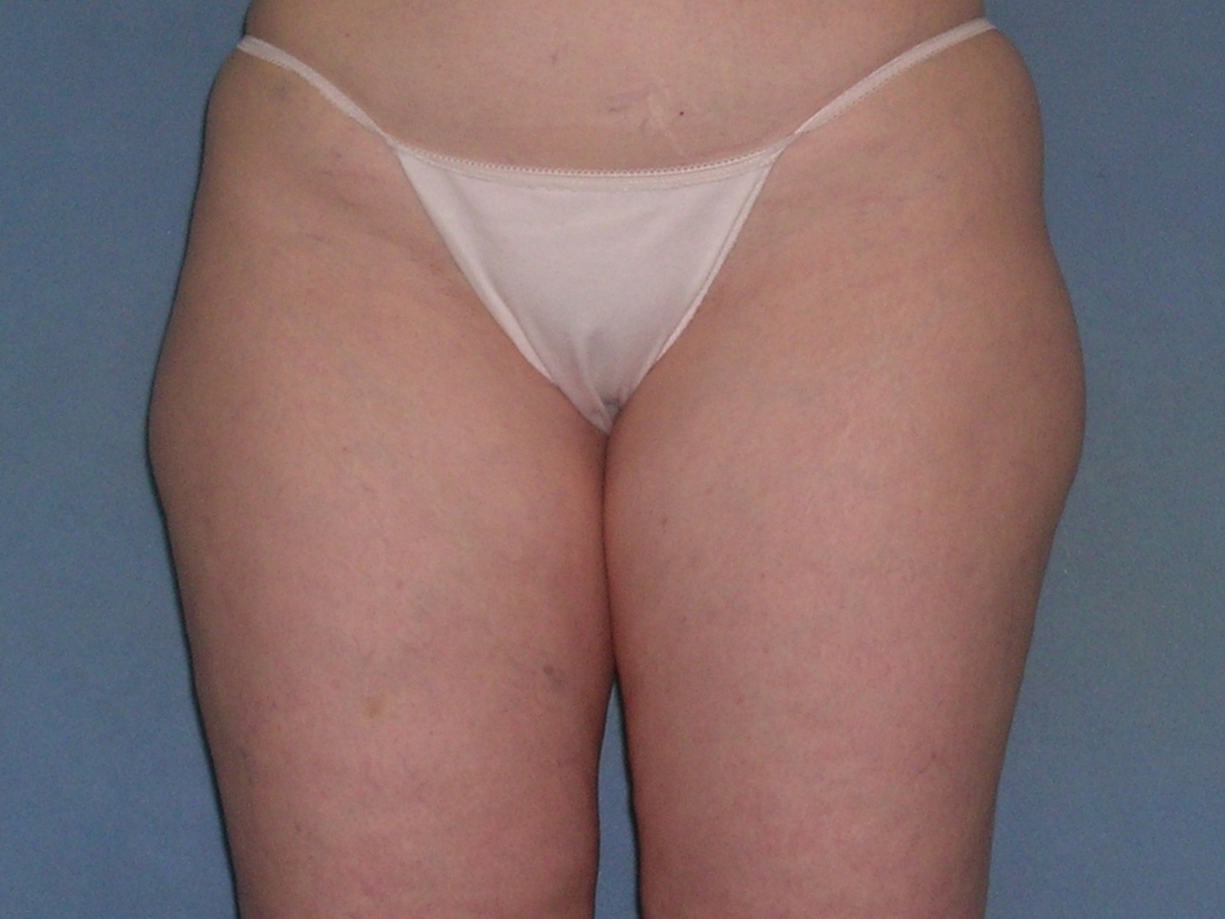 Thigh Lift Before and After Photos