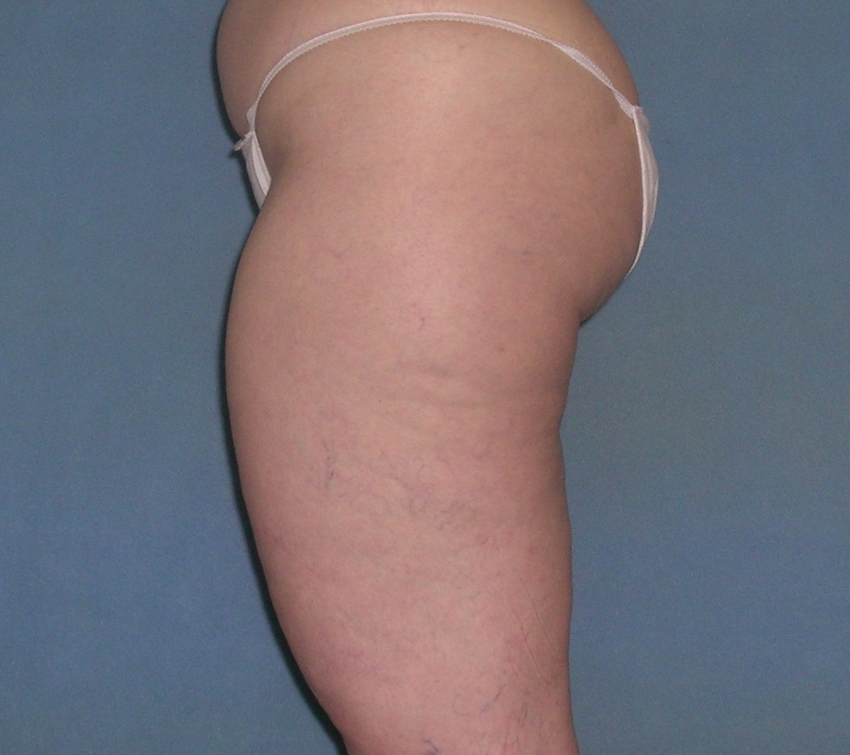 Thigh Lift Before and After Photos