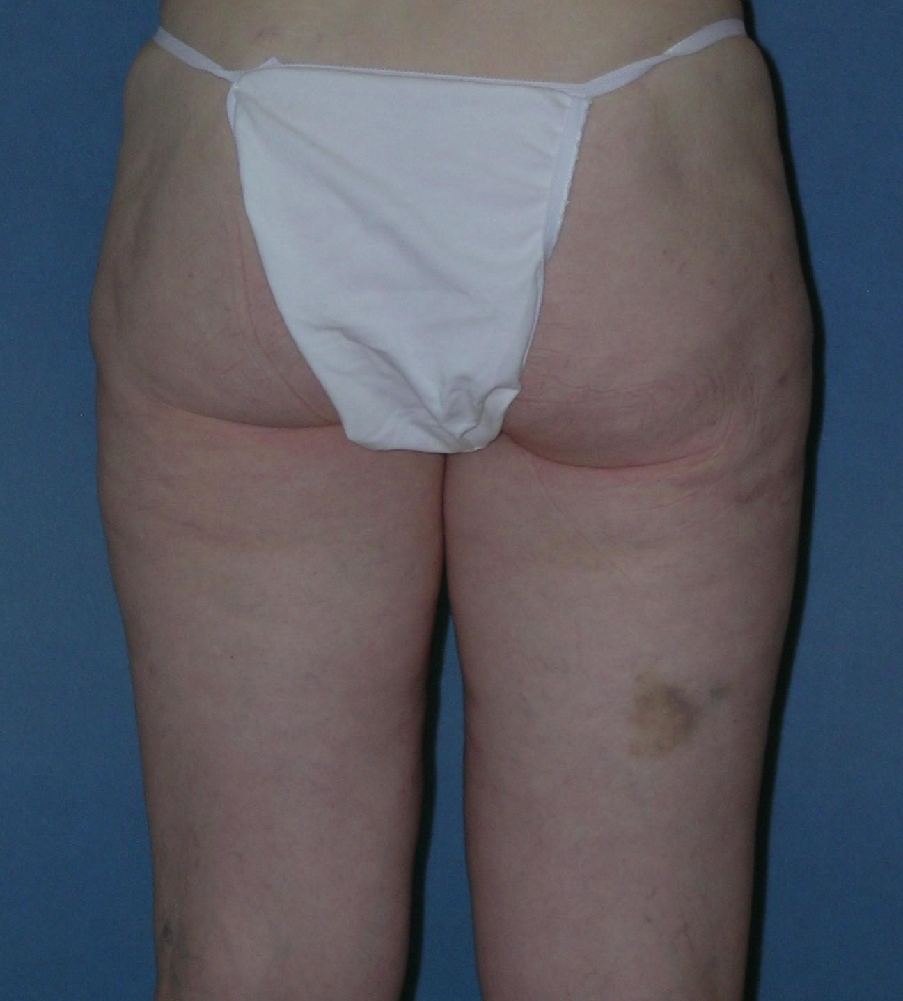 Thigh Lift Before and After Photos