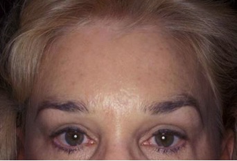 Endoscopic Forehead Lift Before and After Photos