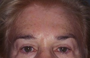 Endoscopic Forehead Lift