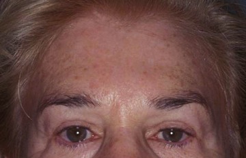 Endoscopic Forehead Lift Before and After Photos