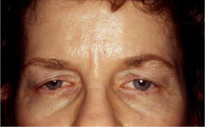 Endoscopic Forehead Lift Before and After Photos