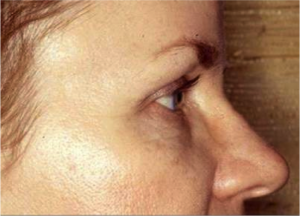 Endoscopic Forehead Lift Case 3802 After Photo Endoscopic Forehead Lift