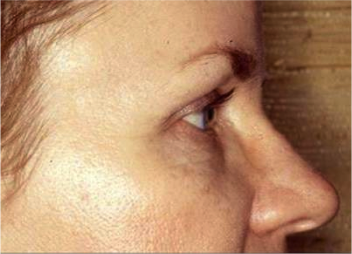 Endoscopic Forehead Lift Before and After Photos