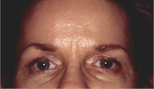 Endoscopic Forehead Lift Case 3802 After Photo Endoscopic Forehead Lift