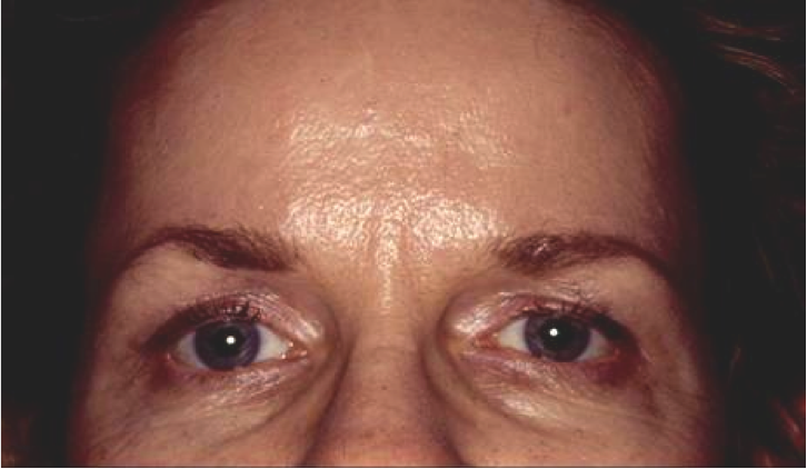 Endoscopic Forehead Lift Before and After Photos