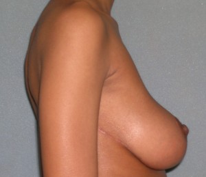 Breast Reduction Case 3807 After Photo Breast Reduction