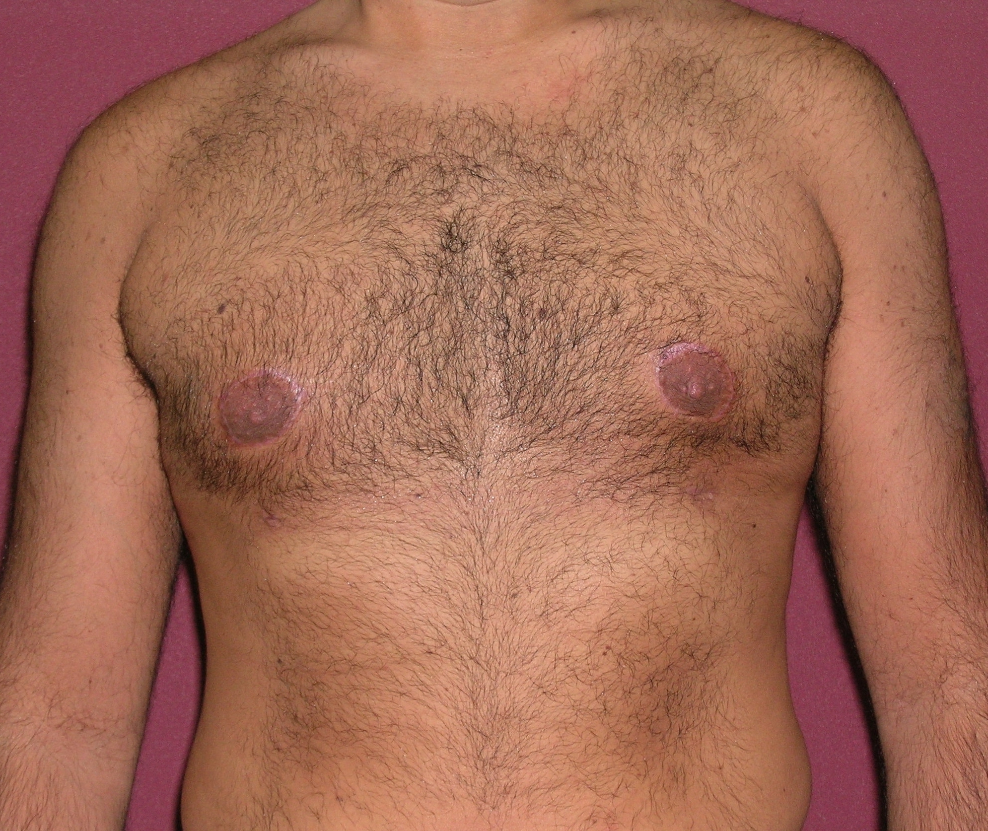 Male Breast Reduction Before and After Photos | Dr. Balakhani