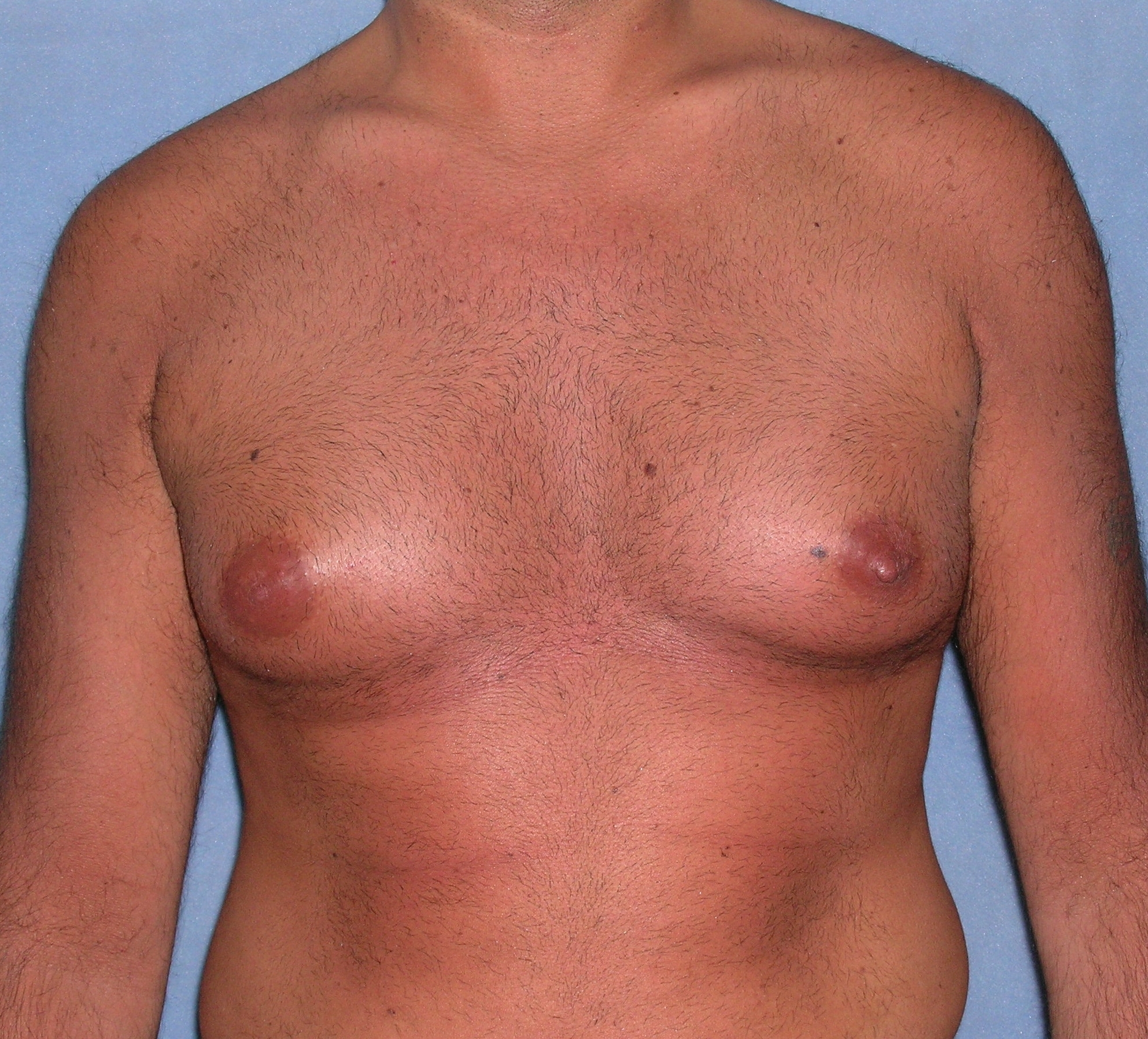 Male Breast Reduction Before and After Photos | Dr. Balakhani
