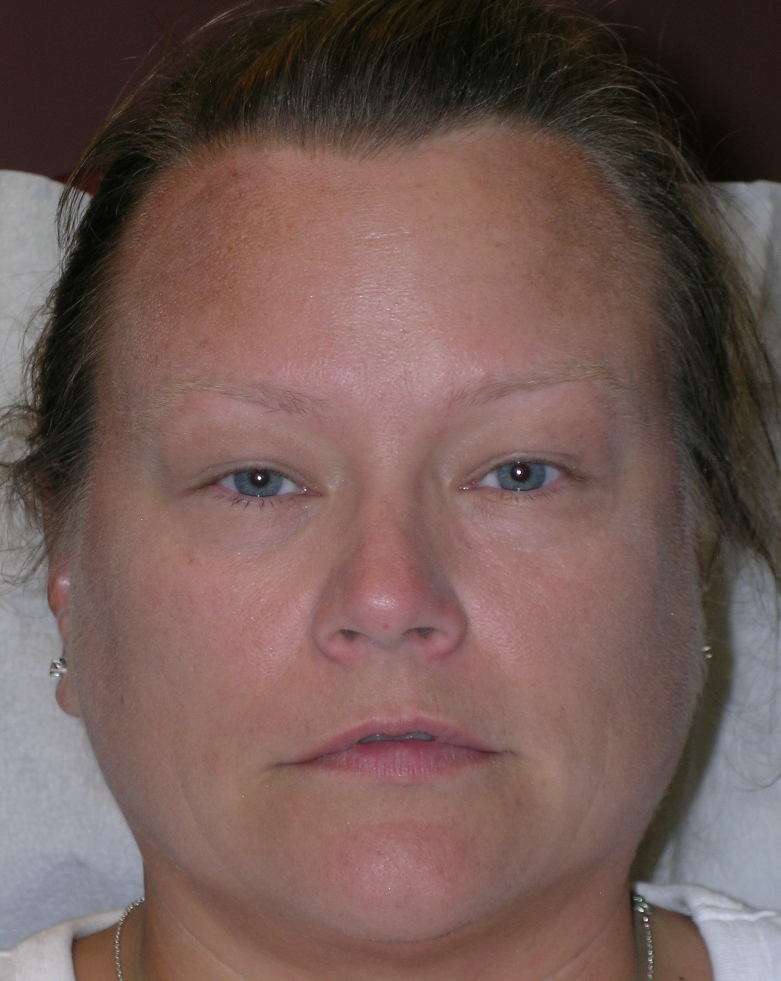 Botulinum Toxin Before and After Photos