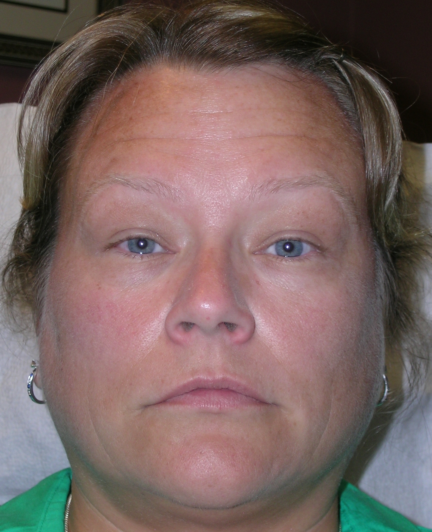 Botulinum Toxin Before and After Photos