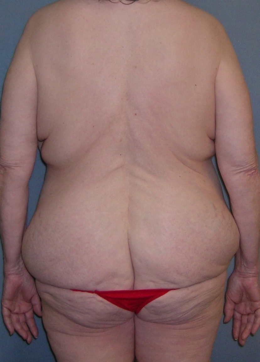 Before After Photos Belt Lipectomy