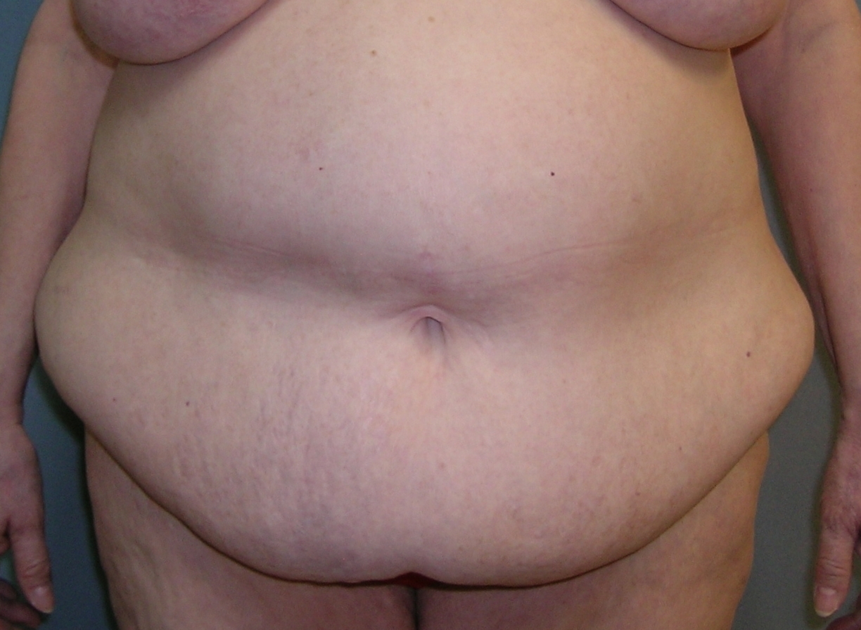 Before After Photos Belt Lipectomy