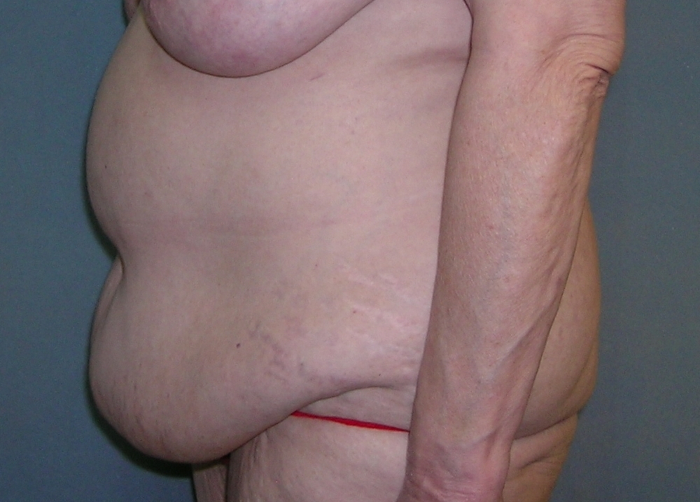 Before After Photos Belt Lipectomy