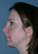 Rhinoplasty