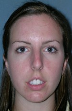 Rhinoplasty