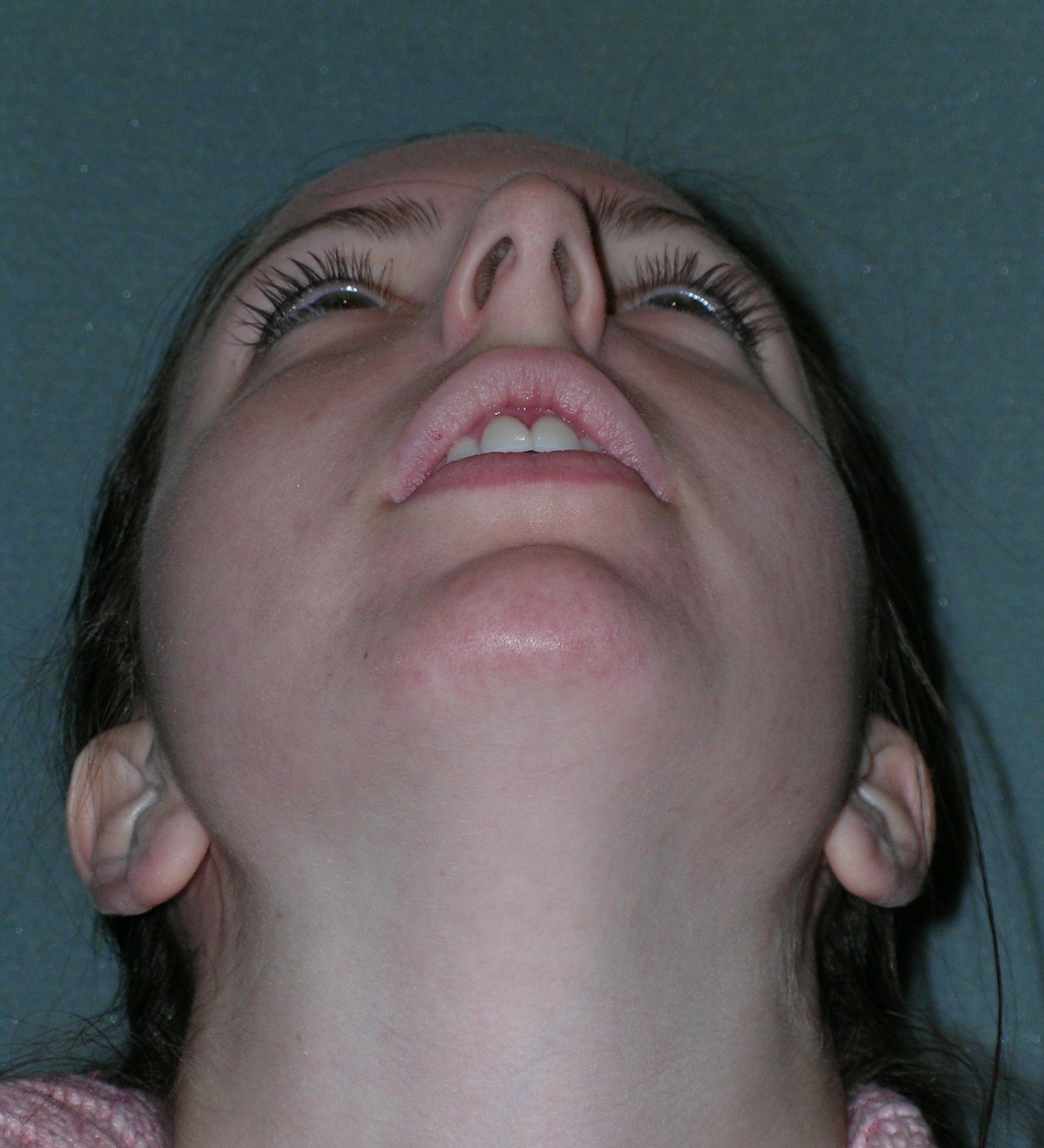 Rhinoplasty Before and After Photos | Dr. Balakhani